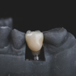 Restoring Function and Confidence After Tooth Loss
